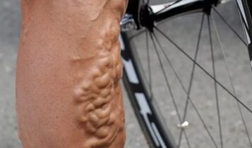 Varicose veins in a cyclist