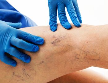 Varicose veins on the legs