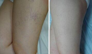 Veins before and after applying the gel