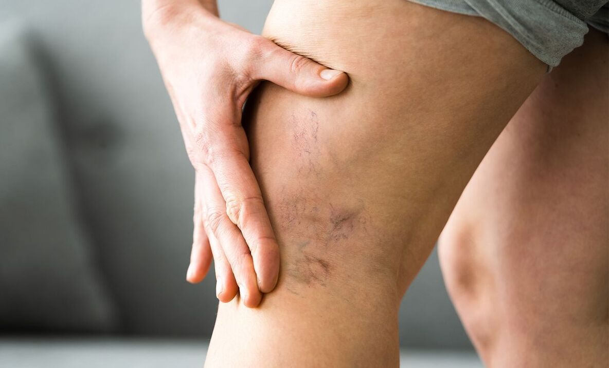 Signs of varicose veins